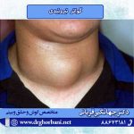 گواتر تیروئیدی