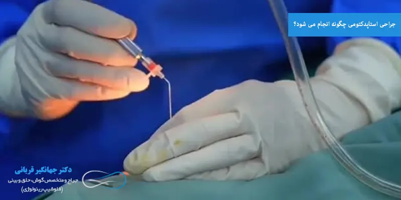 جراحی استاپدکتومی چگونه انجام می شود؟